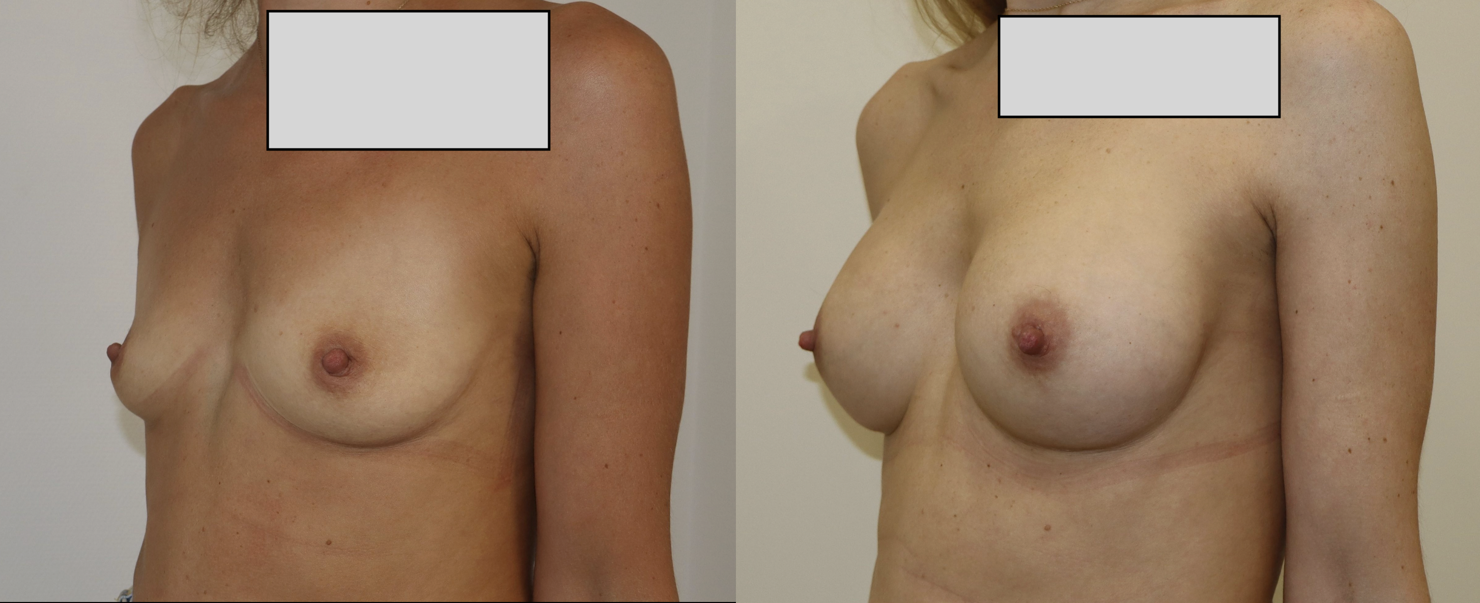 Avant/Après prothèses mammaires